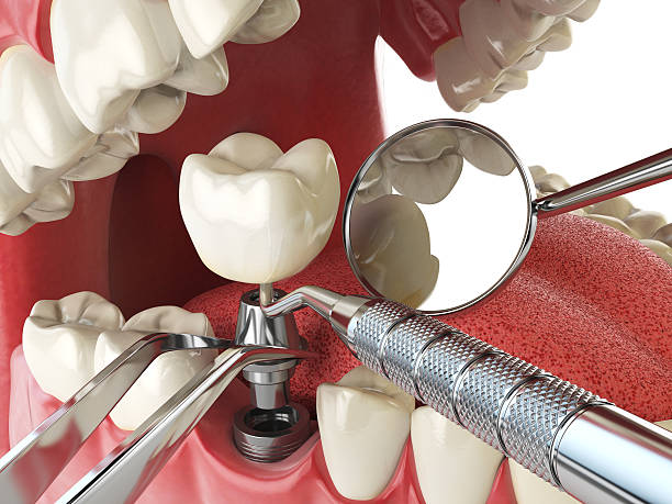 Best Emergency Root Canal Treatment in Neoga, IL